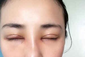 沈陽一大二院整形外科好不好隆鼻2021價格|案例