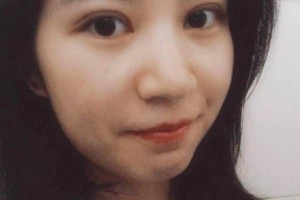 ?復旦大學附屬中山醫(yī)院怎么樣？附埋線雙眼皮果圖