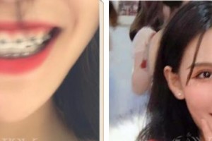 酒泉市口腔醫(yī)院孫吉峰整形價(jià)格表附金屬托槽矯正案例展示