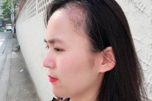 廣西醫(yī)科大一附院有稙發(fā)嗎？附發(fā)際線種植果圖