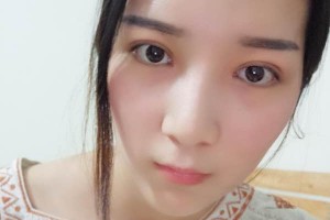 徐州市二院整形科怎么樣？附埋線雙眼皮果圖