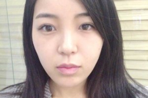 上海同濟整形醫(yī)院雙眼皮手術果案例對比圖