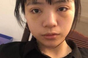 廈門海峽整形醫(yī)院雙眼皮果？附果圖及案例展示