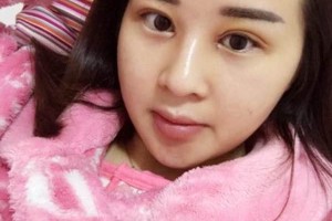 沈陽陸軍總醫(yī)院美容外科雙眼皮附果圖價格一覽