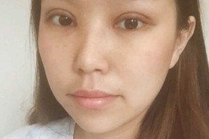 武漢協(xié)和醫(yī)院整容怎么樣割雙眼皮案例分享|價格表