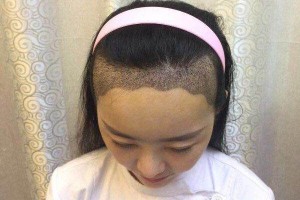 海口市人民醫(yī)院植發(fā)怎樣附果圖