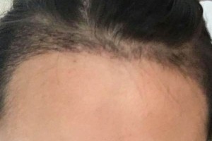 北京同仁醫(yī)院整形美容外科怎么樣？（附果圖）