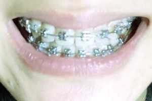 株洲家鴻口腔醫(yī)院牙齒矯正/術后果&價格表