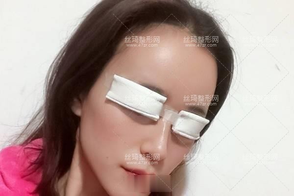 寧波113整形美容醫(yī)院？雙眼皮3個月果|整形專家詳情