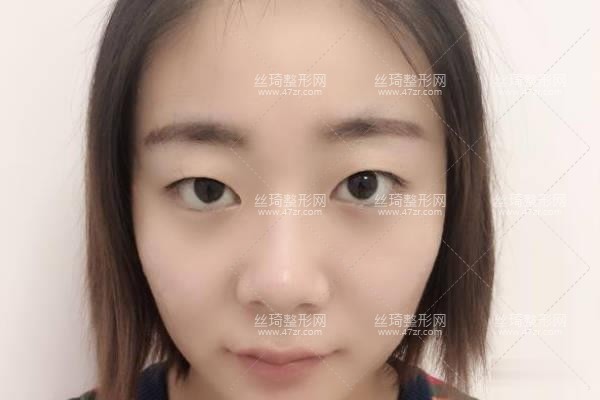 河南省人民醫(yī)院整形科王凱雙眼皮？知名醫(yī)生推薦&費用表