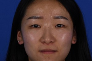 上海永惠華門診部好不好？雙眼皮術后恢復事項