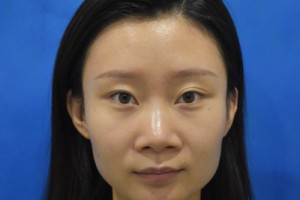 空軍總醫(yī)院隆鼻的費用？2021費用表+醫(yī)生推薦