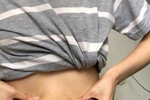 武漢涵美整形醫(yī)院怎么樣？吸脂減肥實(shí)拍—術(shù)后恢復(fù)