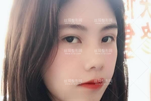 上海九院怎么樣？雙眼皮3個(gè)月果|整形專家詳情