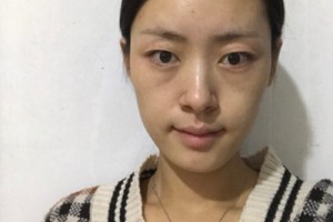 華康整形醫(yī)院正規(guī)嗎？隆鼻成功案例&費用表