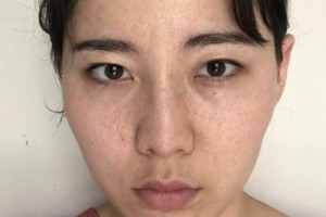 浙一激光美容科？真人實拍對比&費用表