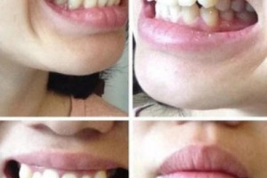 西安中諾口腔醫(yī)院評價(jià)？牙齒矯正成功案例分享！