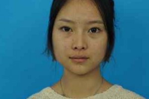 濟南華僑醫(yī)院雙眼皮咋樣？醫(yī)生技術如何/費用表