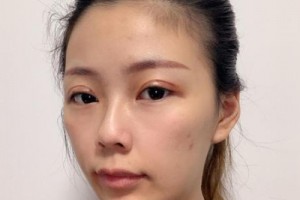 南方醫(yī)院苗勇植發(fā)果好不好？真實案例分享