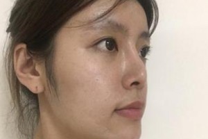 京民整形醫(yī)院假體隆鼻靠譜嗎？親身經(jīng)歷分享&對比圖