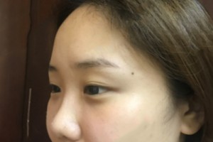 武漢協(xié)和醫(yī)院美容科怎么樣 ？去眼袋果圖