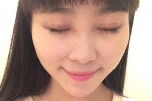 臨沂市人民醫(yī)院雙眼皮怎么樣？注意事項(xiàng)+術(shù)前準(zhǔn)備必看