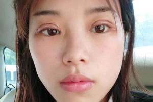 長沙亞韓整形醫(yī)院雙眼皮價格？術后幾點需注意！