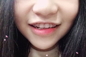 江蘇邳州口腔靠譜嗎？牙齒矯正的價格表!