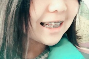 四川華西口腔醫(yī)院？牙齒矯正術(shù)后分享！