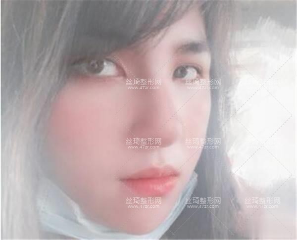 徐州二院激光美膚科隆鼻3個(gè)月果|手術(shù)費(fèi)用