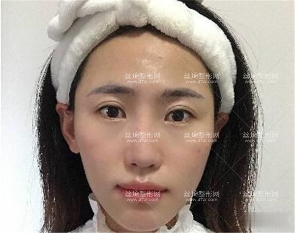 上海第九人民醫(yī)院整形怎么樣？隆鼻案例圖|價(jià)格費(fèi)用