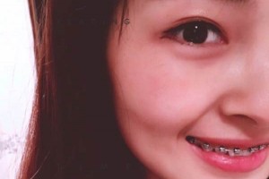 西安中諾口腔牙齒矯正價目表—術后護理分享