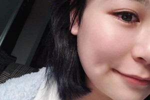 安醫(yī)二附院整形外科下頜角怎么樣？成功案例測評！