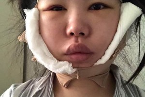 鄭大一附院有整形科怎么樣？下頜角術(shù)真實案例|醫(yī)生推薦