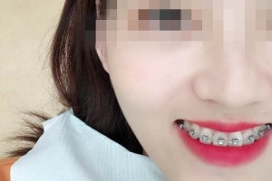 青島優(yōu)諾博士口腔醫(yī)院牙齒矯正怎么樣？恢復圖分享