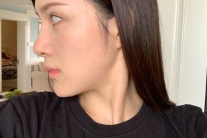 廈門第一醫(yī)院美容科下頜角怎么樣？術(shù)前術(shù)后對比圖！