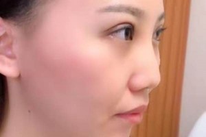 廈門第一醫(yī)院整形科哪位醫(yī)生好？埋線雙眼皮術(shù)后果&價格表