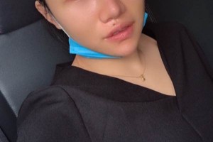 湘雅醫(yī)院皮膚激光中心哪位醫(yī)生好？眼部手術(shù)術(shù)前術(shù)后果對比！