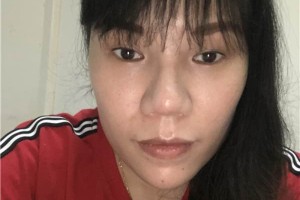 無(wú)錫人民醫(yī)院膨體隆鼻怎么樣？真實(shí)案例分享！