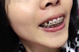 北京億大口腔醫(yī)院牙齒矯正怎么樣？附較新價格表！