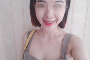 南京口腔醫(yī)院牙齒矯正哪個(gè)醫(yī)生好/真實(shí)案例對(duì)比！