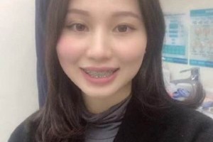 濟南圣貝口腔醫(yī)院牙齒矯正怎么樣/真實案例對比！