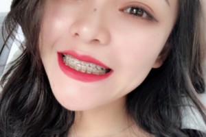 重慶美奧口腔醫(yī)院怎么樣？附醫(yī)院信息+正畸果圖