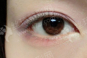 西安做雙眼皮醫(yī)生排行榜醫(yī)生優(yōu)勢簡介|醫(yī)生優(yōu)勢介紹，雙眼皮項目術(shù)后體驗感受點評